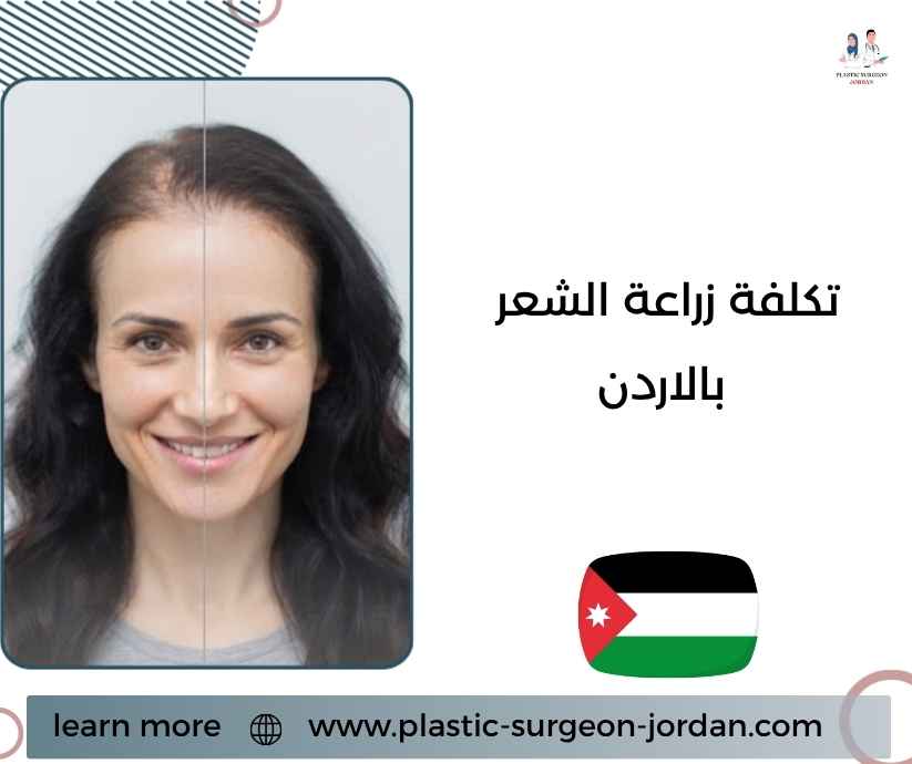 تكلفة زراعة الشعر بالاردن