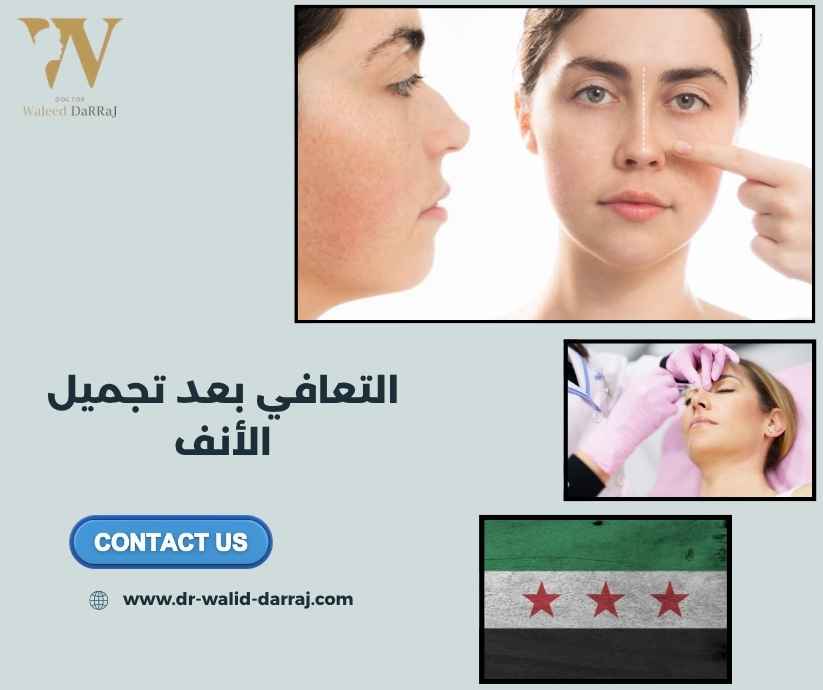 التعافي بعد تجميل الأنف