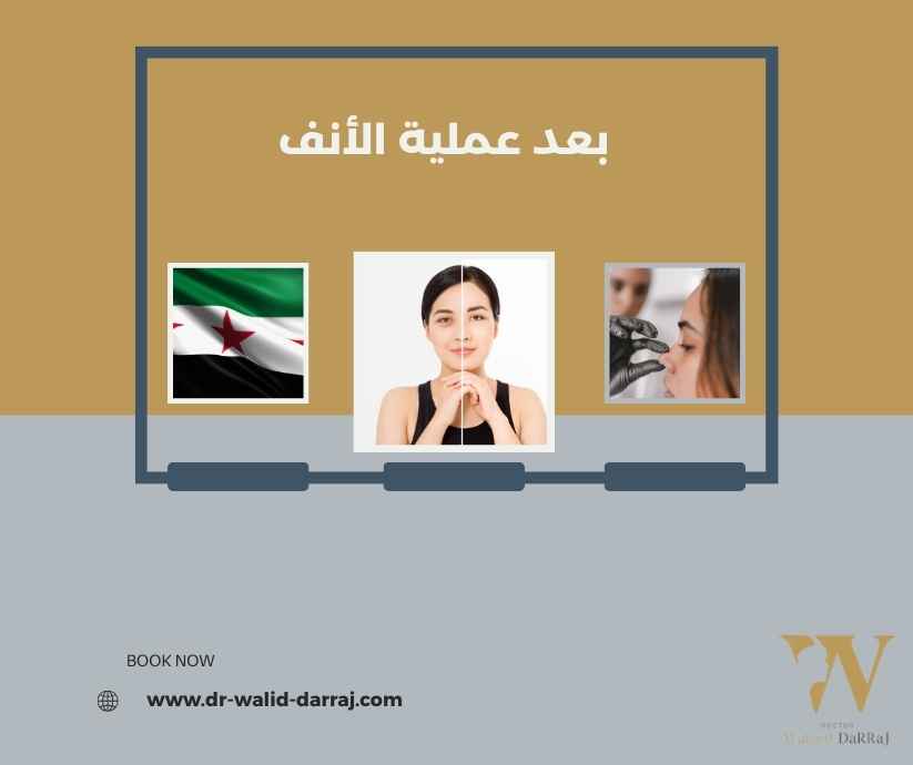 بعد عملية الأنف
