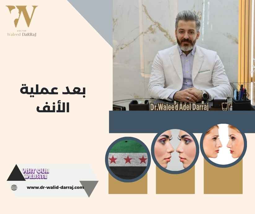 بعد عملية الأنف