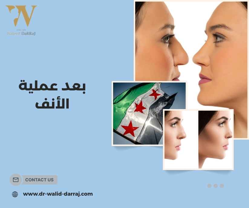 بعد عملية الأنف