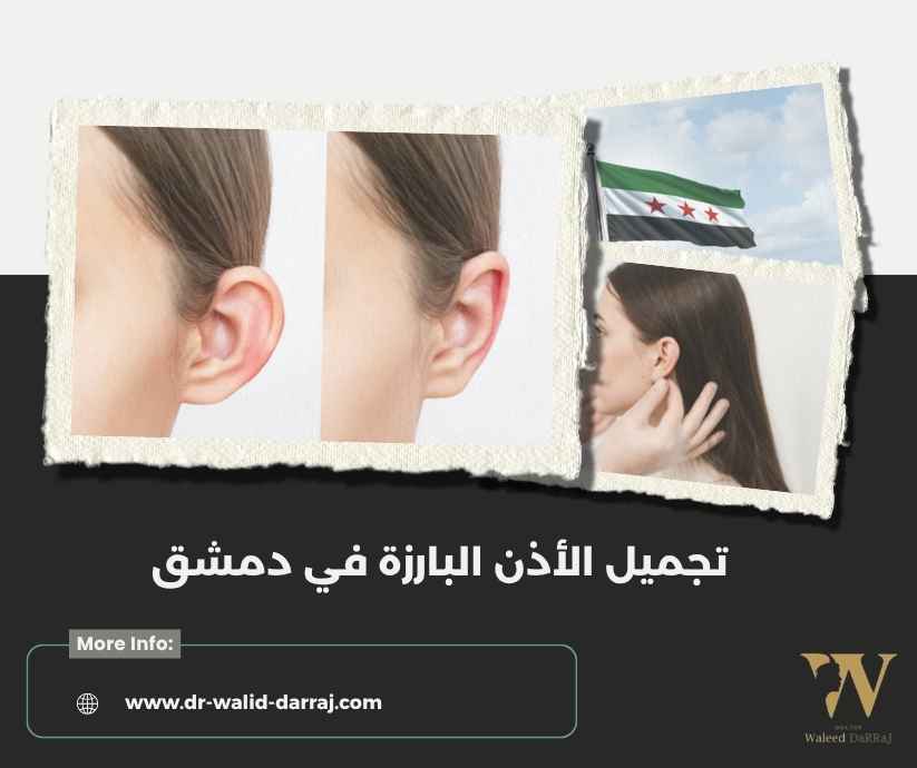 تجميل الأذن البارزة في دمشق