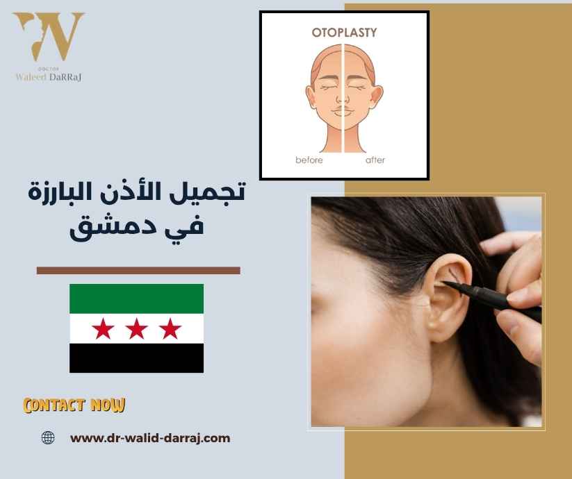 تجميل الأذن البارزة في دمشق