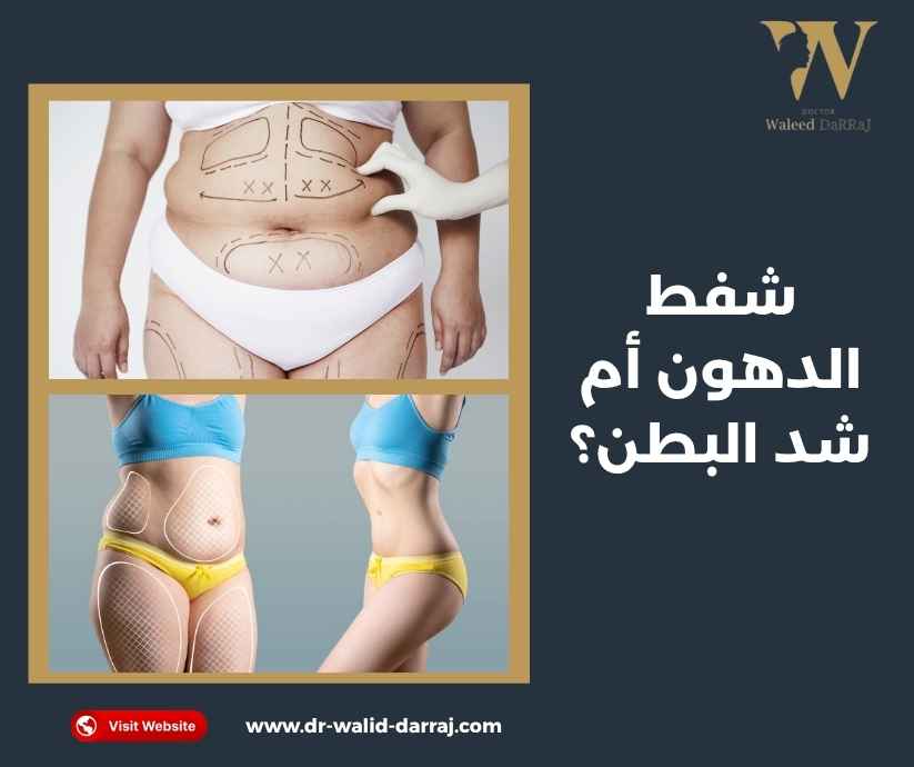 شفط الدهون أم شد البطن شفط الدهون أم شد البطن
