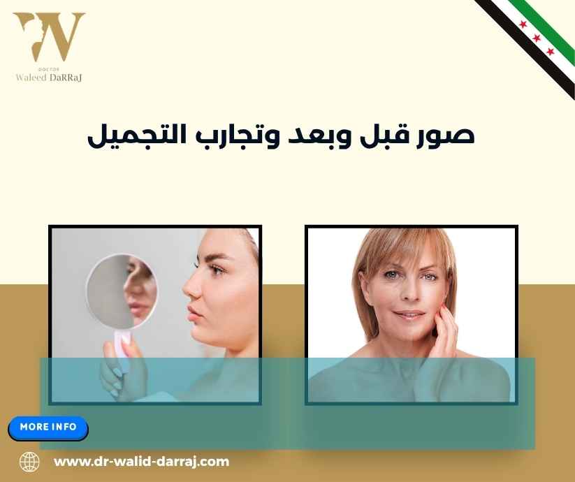 صور قبل وبعد وتجارب التجميل صور قبل وبعد وتجارب التجميل