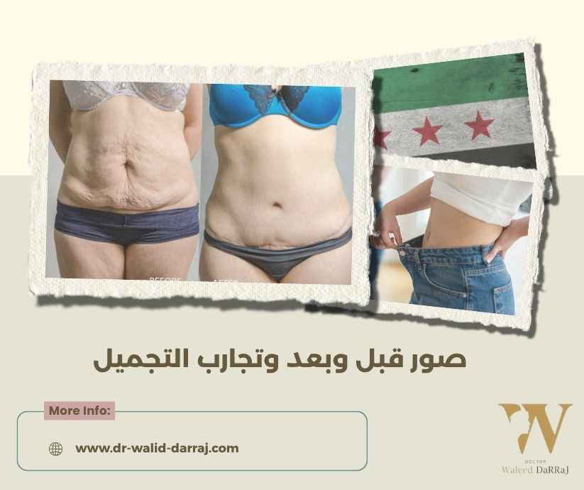 صور قبل وبعد وتجارب التجميل صور قبل وبعد وتجارب التجميل